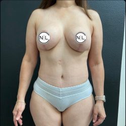 Abdominoplasty Before & After Patient #14849