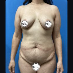 Abdominoplasty Before & After Patient #14849