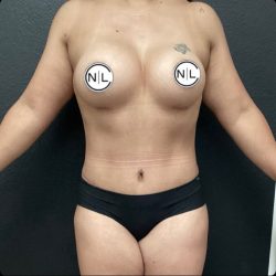 Mommy Makeover Before & After Patient #14862