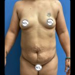 Mommy Makeover Before & After Patient #14862