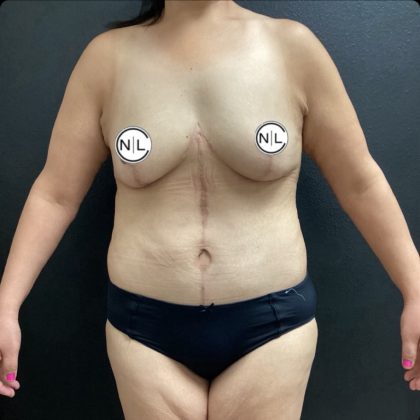 Abdominoplasty Fleur-de-lis Before & After Patient #14861