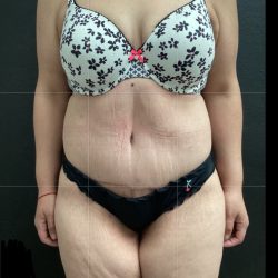 Abdominoplasty Before & After Patient #14860