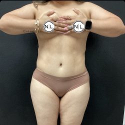 Abdominoplasty Before & After Patient #14859