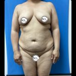 Abdominoplasty Before & After Patient #14859