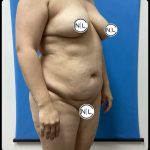Abdominoplasty Before & After Patient #14859