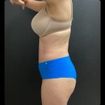Abdominoplasty Before & After Patient #14858