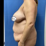Abdominoplasty Before & After Patient #14857