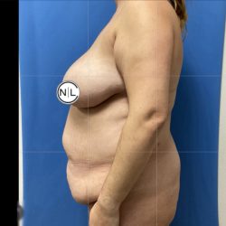 Abdominoplasty Before & After Patient #14857
