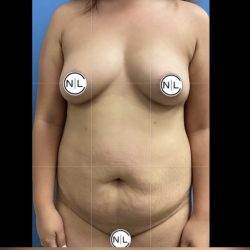 Mommy Makeover Before & After Patient #14856