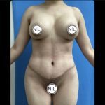 Abdominoplasty Before & After Patient #14855