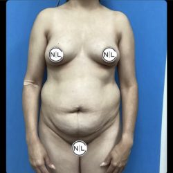 Abdominoplasty Before & After Patient #14855