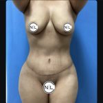 Abdominoplasty Before & After Patient #14854