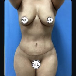 Abdominoplasty Before & After Patient #14854