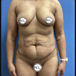 Abdominoplasty Before & After Patient #14854