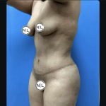 Abdominoplasty Before & After Patient #14854