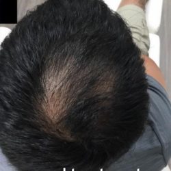 PRP Treatments Before & After Patient #15597
