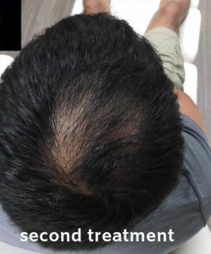 PRP Treatments Before & After Patient #15597