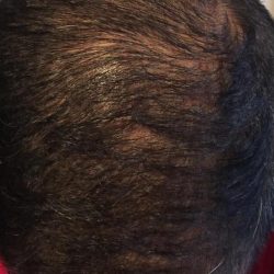 PRP Treatments Before & After Patient #15600