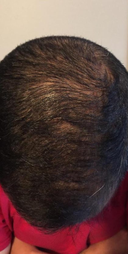 PRP Treatments Before & After Patient #15600
