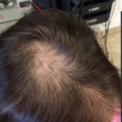 PRP Treatments Before & After Patient #15593