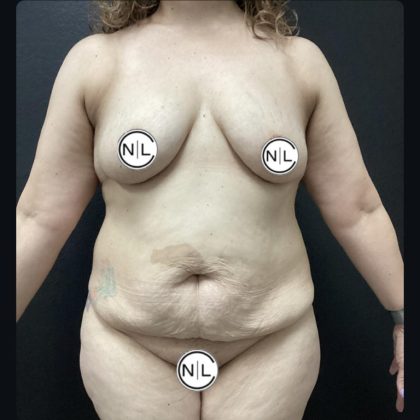 Breast Augmentation Before & After Patient #15603