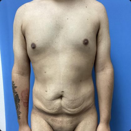Abdominoplasty Before & After Patient #15609