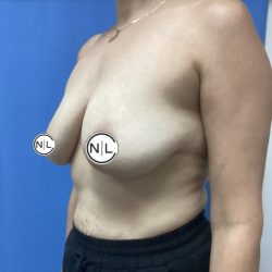 Breast Augmentation Before & After Patient #15614