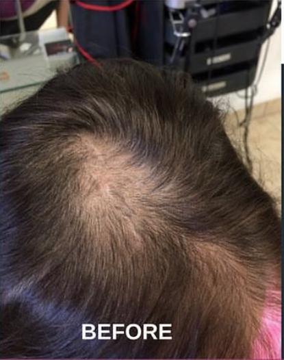 PRP Treatments Before & After Patient #15593