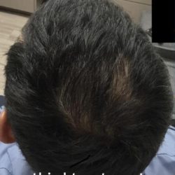 PRP Treatments Before & After Patient #15597