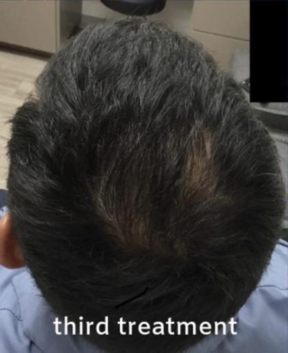 PRP Treatments Before & After Patient #15597