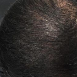 PRP Treatments Before & After Patient #15600