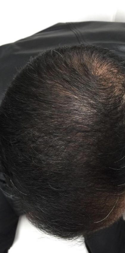 PRP Treatments Before & After Patient #15600