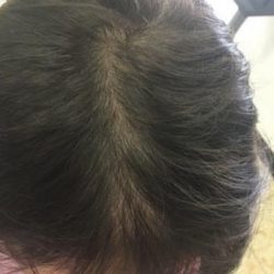 PRP Treatments Before & After Patient #15593