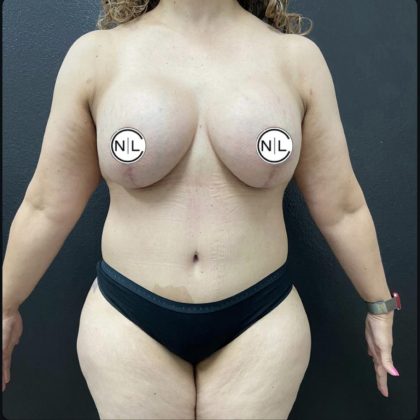 Breast Augmentation Before & After Patient #15603