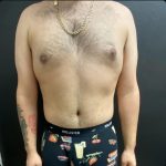 Abdominoplasty Before & After Patient #15609