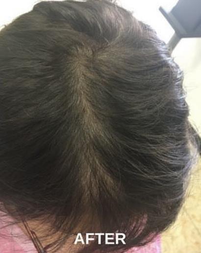 PRP Treatments Before & After Patient #15593