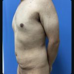 Abdominoplasty Before & After Patient #15609