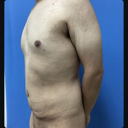 Abdominoplasty Before & After Patient #15609