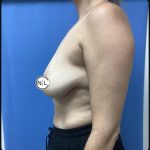 Breast Augmentation Before & After Patient #15614