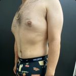 Abdominoplasty Before & After Patient #15609