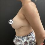 Breast Augmentation Before & After Patient #15614