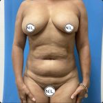 Abdominoplasty Before & After Patient #15648