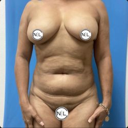 Abdominoplasty Before & After Patient #15648