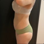 Brazilian Butt Lift Before & After Patient #15647