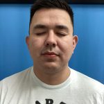 Jawline/Neck - For Men Before & After Patient #15577