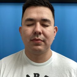 Jawline/Neck - For Men Before & After Patient #15577