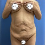 Abdominoplasty Before & After Patient #15686