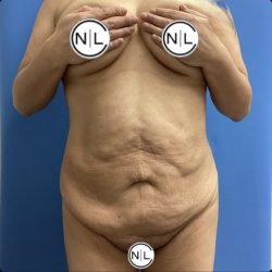 Abdominoplasty Before & After Patient #15686