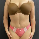Abdominoplasty Before & After Patient #15686