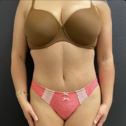 Abdominoplasty Before & After Patient #15686